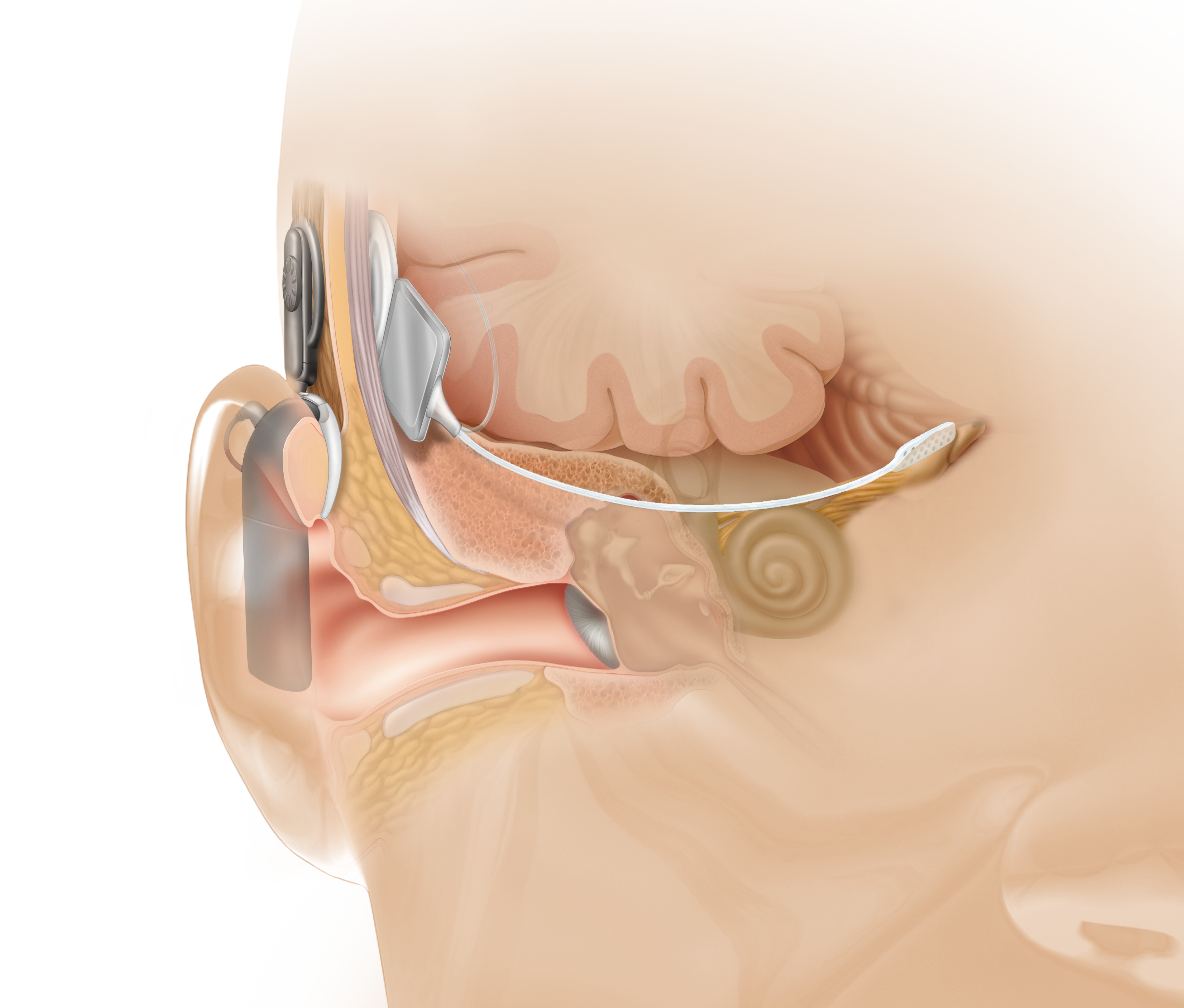 Слуховой аппарат внутреннего уха. Имплантируемые слуховые аппараты среднего уха. Слуховой аппарат Кохлер имплант. Аппарат слух Cochlear операция. Кохлеарная имплантация операция.