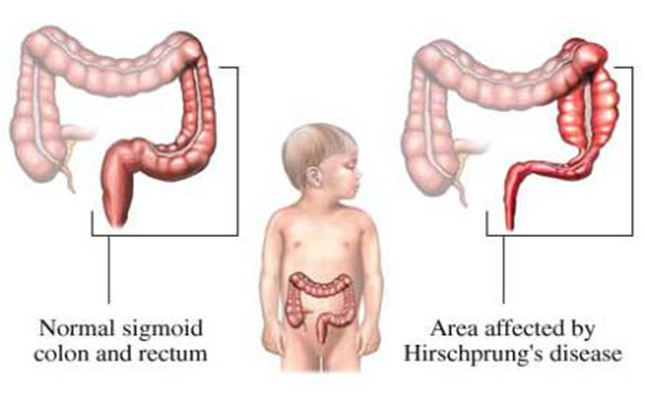 Спазмы кишечника у ребенка