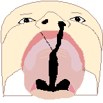 Cleft lip max palate left bot.png