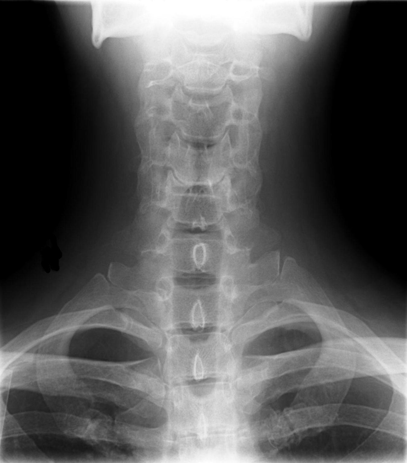 Рентген шейного отдела позвоночника. Cervical Spine XRAY. Снимок шейного отдела позвоночника здорового человека. Рентгенография шейно-дорсального отдела позвоночника. Рентген мягких тканей спины.