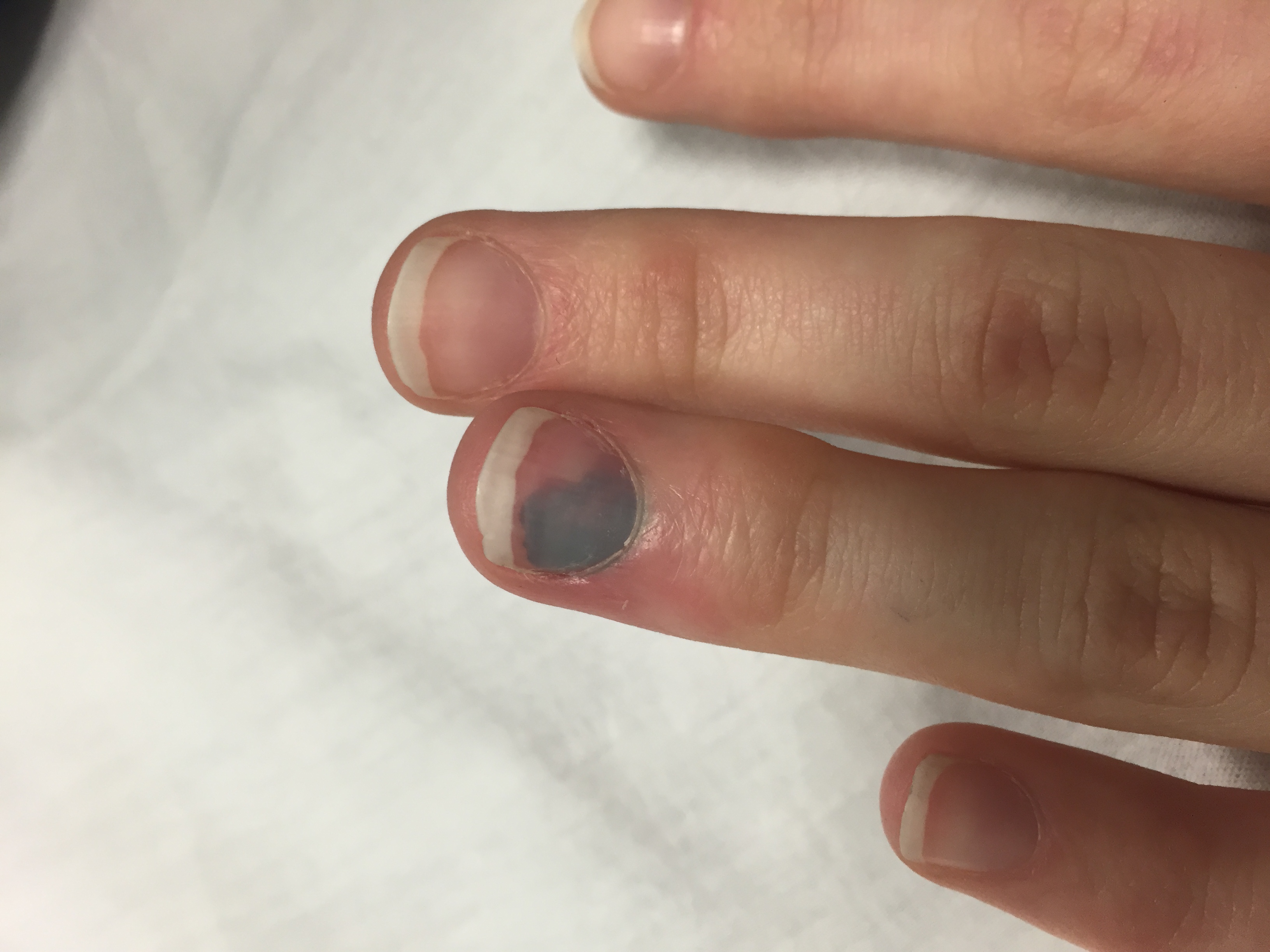 Травма пальца руки: Травмы/разрывы сухожилий сгибателей и ра