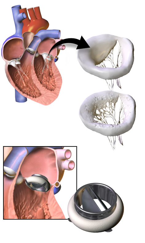 Клапан сердца искусственный фото