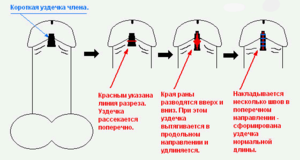 Разрыв уздечки у мужчин - методы лечения