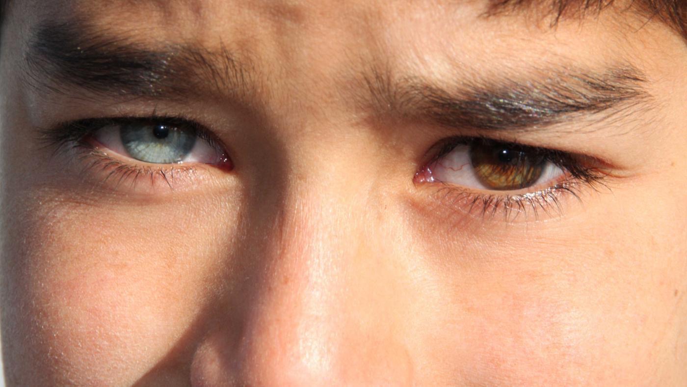 Левый глаз темнее правого. Гетерохромия карих глаз. Центральная гетерохромия глаз. Гетерохромия голубой и Карий.