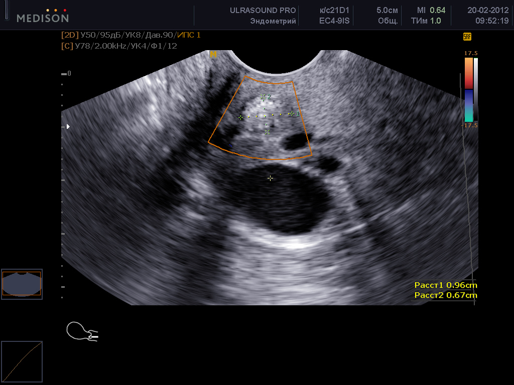 Как на узи выглядит киста матки фото