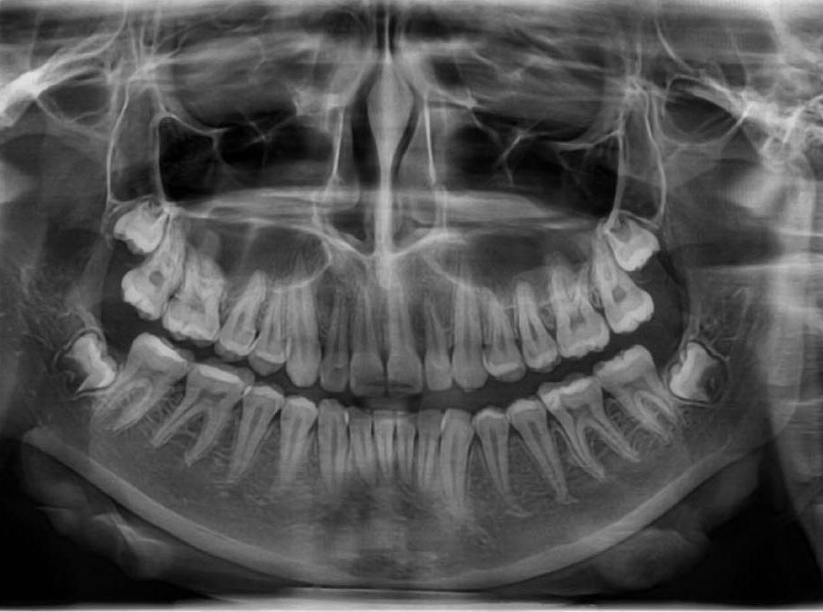 Рентген челюсти фото