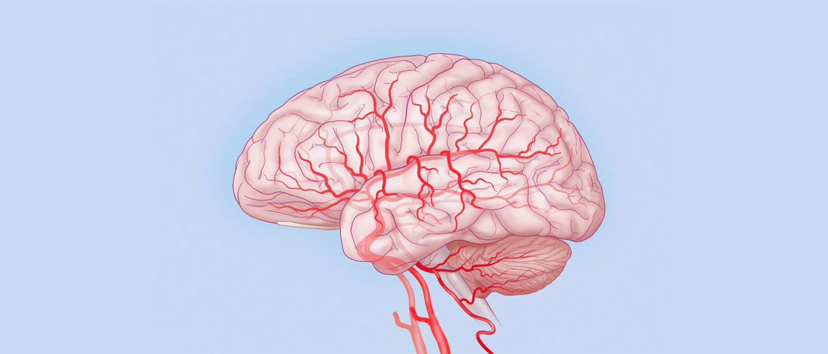 Нейросифилис: поражение сосудов мозга