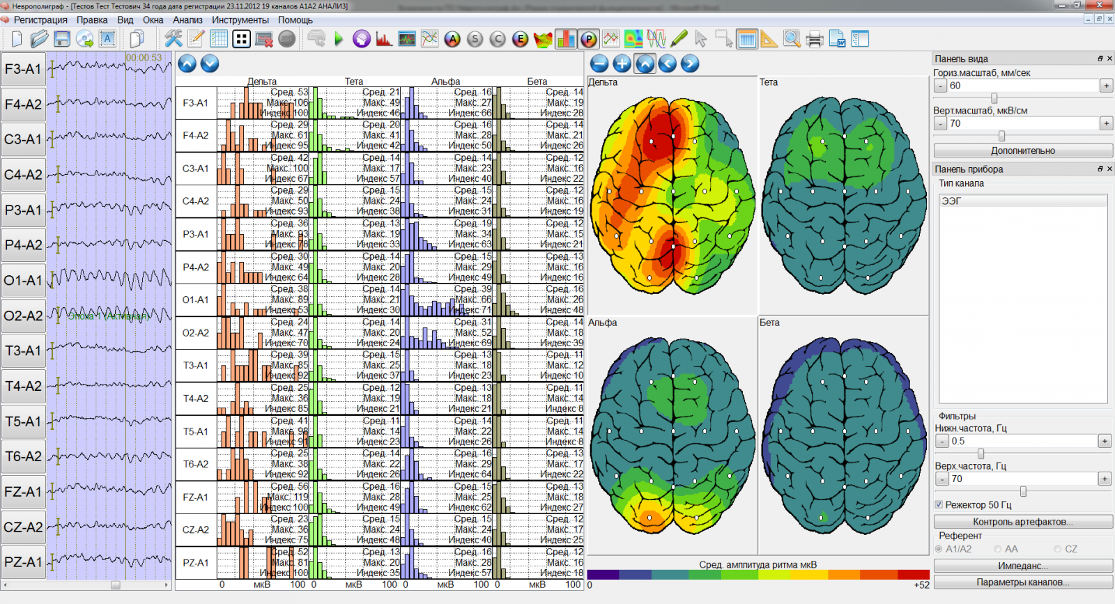 Энцефалограмма расшифровка результатов. Топографическое картирование электрической активности мозга. Картирование ЭЭГ. ЭЭГ картирование головного мозга. Электрическая активность головного мозга
