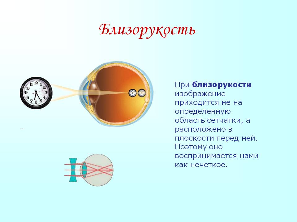 Миопия сетчатки. Миопия близорукость глаз. Заболевания органа зрения близорукость и дальнозоркость. Строение глаза при близорукости и дальнозоркости. Миопия и гиперметропия.
