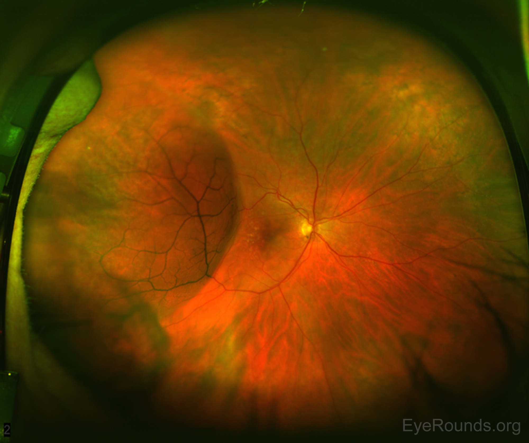 Диагноз сетчатки. Ретиношизис дистрофия сетчатки. Периферический дегенеративный ретиношизис. Кистовидный ретиношизис.