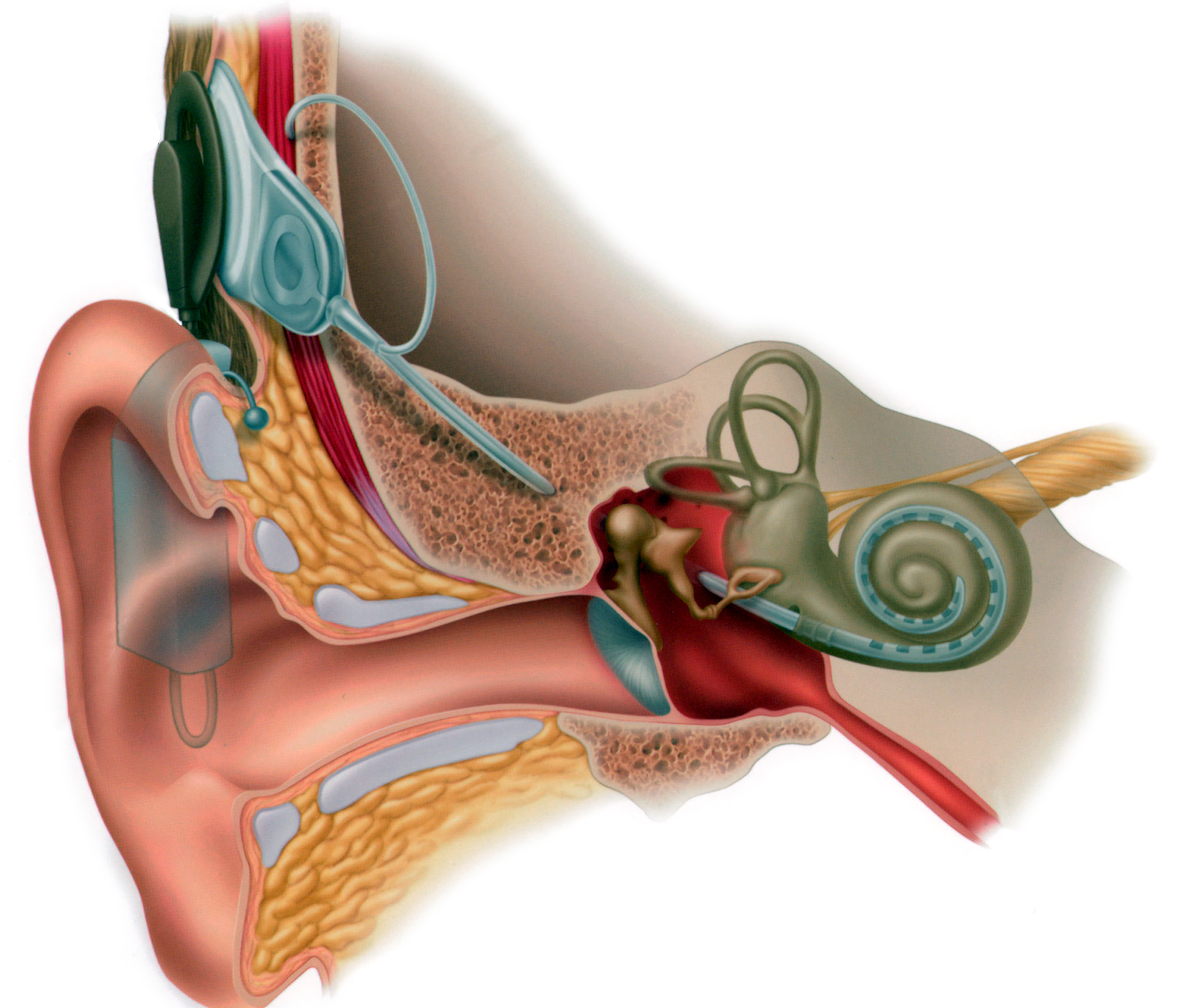Кохлеарный имплант. Международный день кохлеарного импланта. Кохлеарный аппарат анатомия.