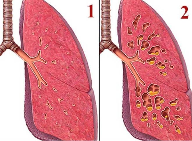 пневмофиброз легких пневмофиброз легких