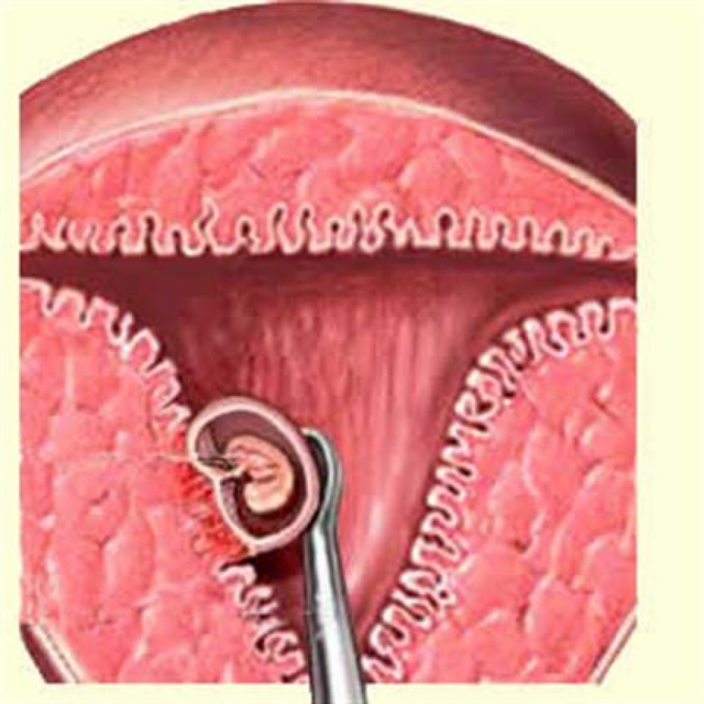 Спираль при гиперплазии эндометрия
