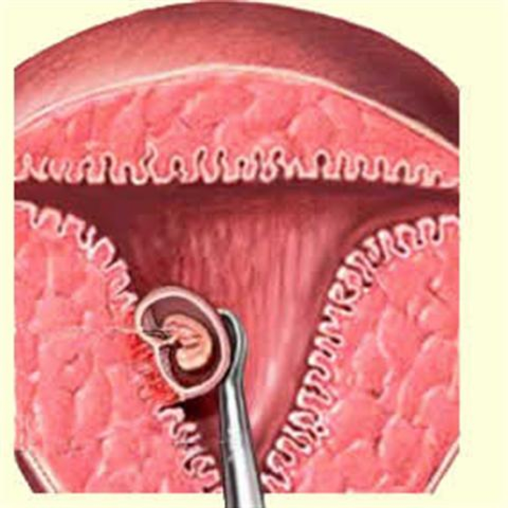Выскабливание эндометрия