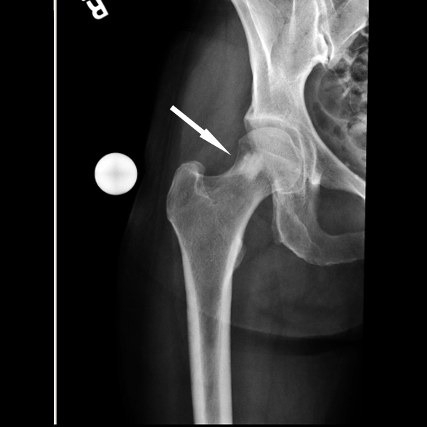 Остеома бедренной кости рентген картина