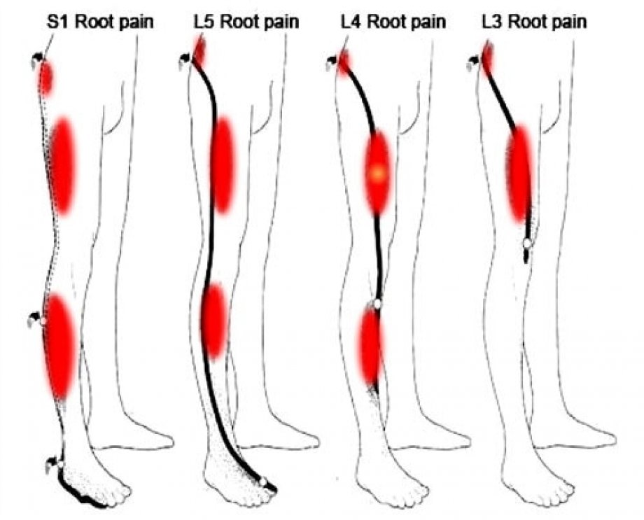 Почему отдает в левую ногу. Радикулопатия s1 корешка. Радикулопатия l1. Радикулопатия l3-l4. Триггерные точки икроножной мышцы.