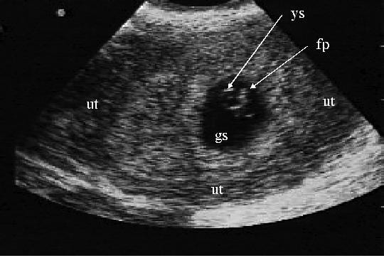 Внематочная беременность узи фото как выглядит