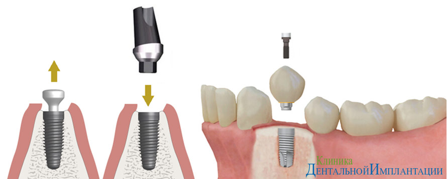 Установка импланта зуба этапы с фото пошагово