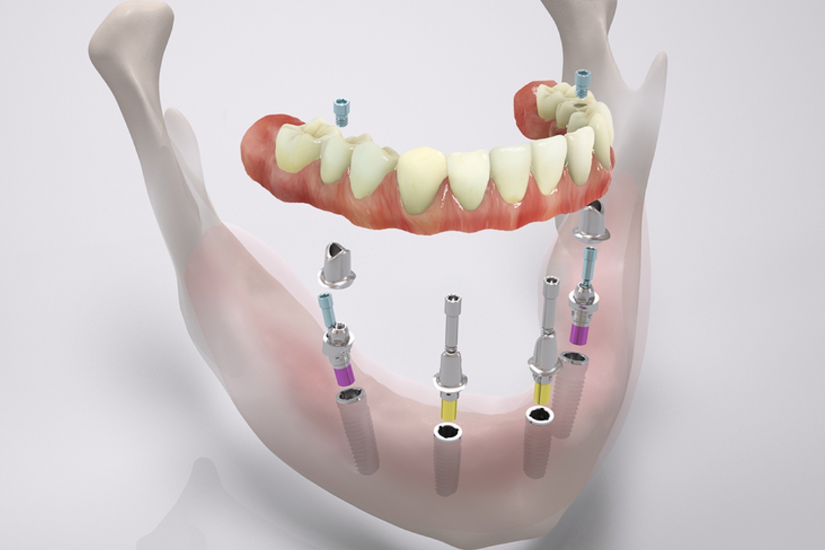 Имплантация зубов all on 6. Импланты Straumann Pro Arch. (Метод имплантации all-on-4)методы. Несъемные зубные протезы.