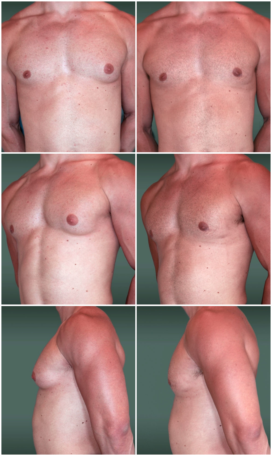 увеличенный сосок груди у мужчин фото 21