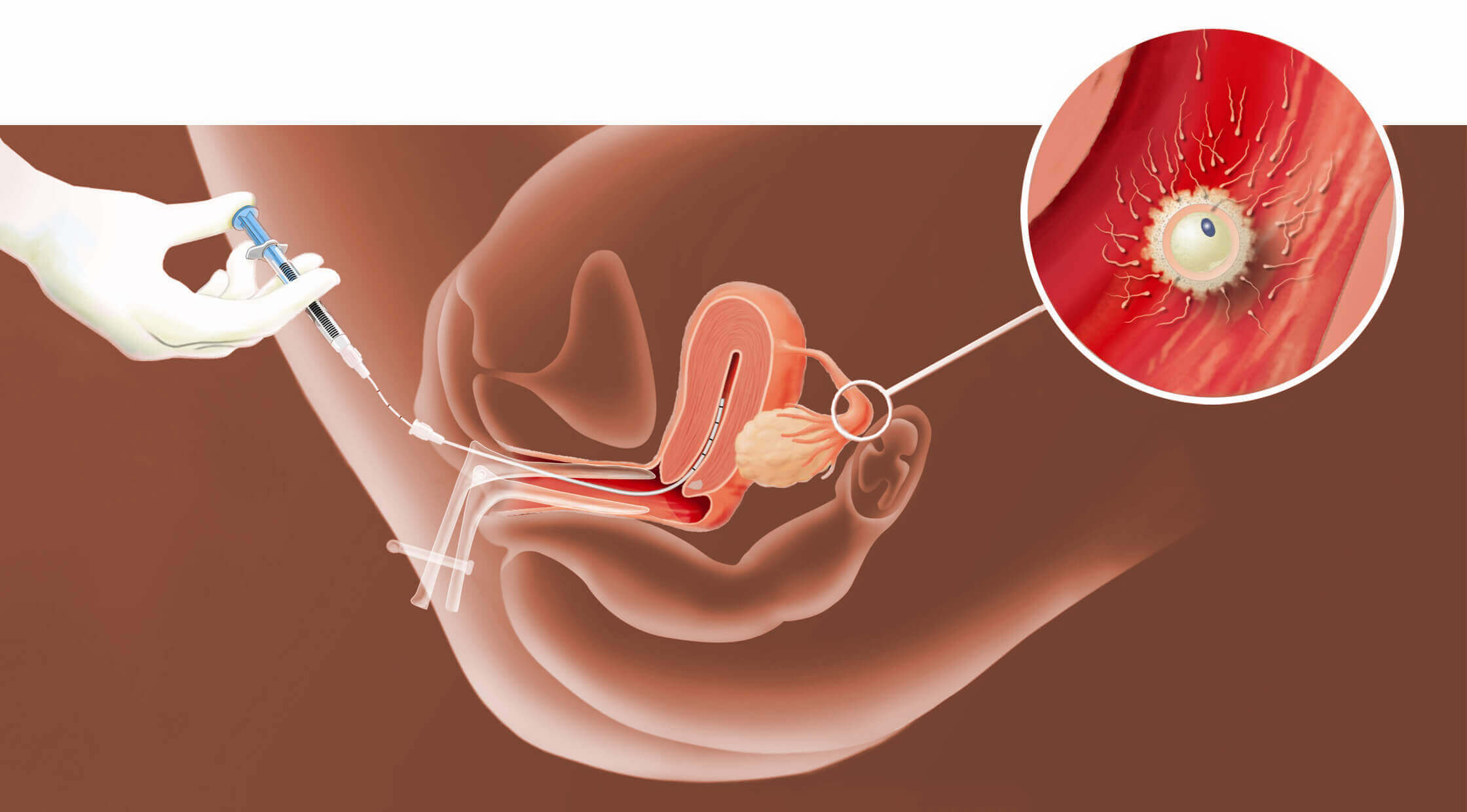 процедура введения спермы в матку фото 17