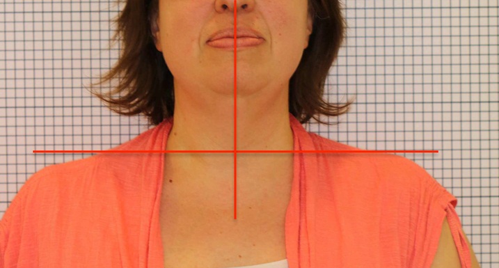 Before the tongue-tie surgery. Notice the right shoulder, lower than the left and asymmetrical muscle tension in the face and neck. 