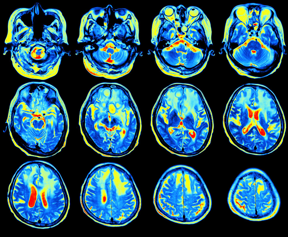 Можно ли мрт с ретейнерами. Функциональная магнитно-резонансная томография (ФМРТ). Functional Magnetic Resonance Imaging (FMRI). Мрт и ФМРТ. Кт головного мозга с контрастом.