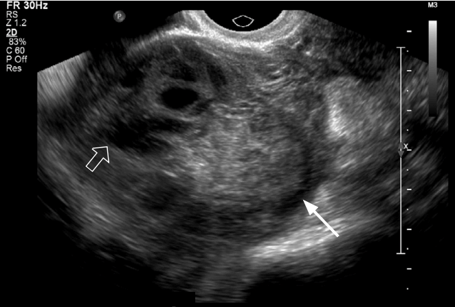 Внематочная беременность узи фото