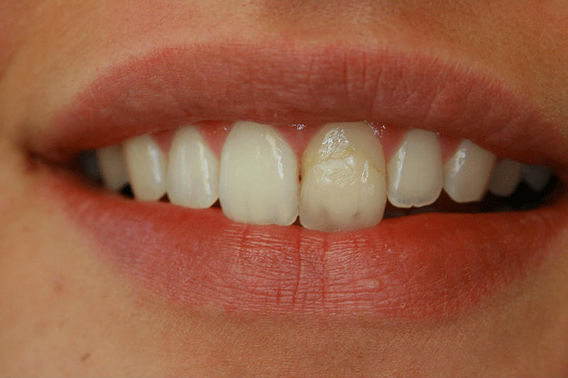 отбеливание зубов если зубы в пломбах