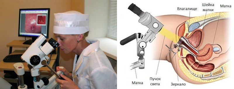 Кольпоскопия шейки матки что. Эрозия шейки матки кольпоскопия. Кольпоскопия эрозии шейки. Микроскопия шейки матки. Кольпоскопическое исследование шейки.