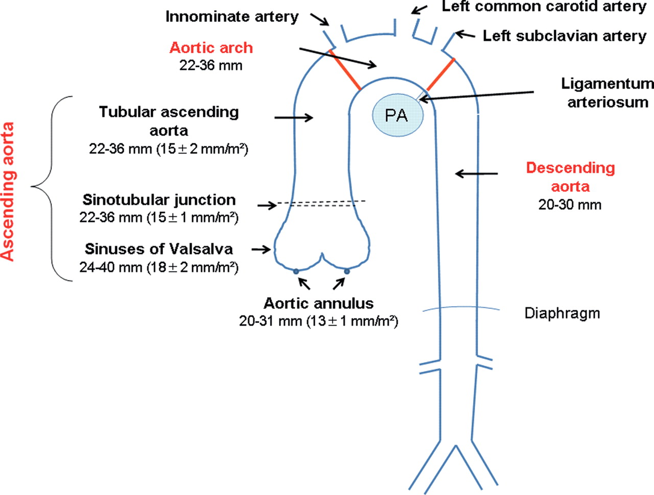 Синус вальсальвы это. Диаметр аорты на уровне синусов Вальсальвы. Размер аорты на уровне синусов Вальсальвы норма. Диаметр аорты на уровне синусов Вальсальвы норма. Нормальный диаметр восходящего отдела аорты.