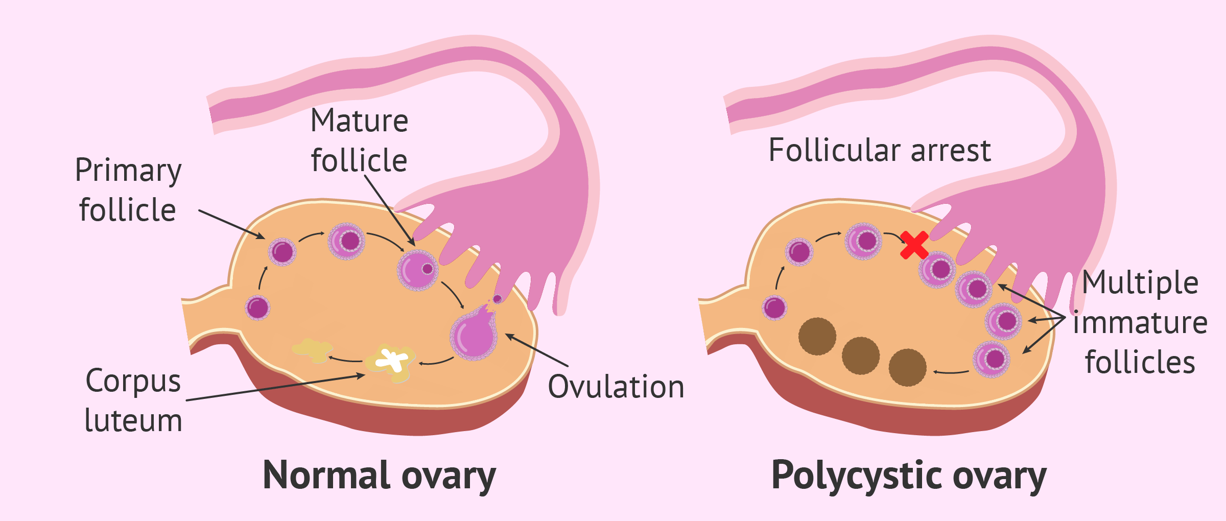 Ovarios poliquísticos anticonceptivos recomendados