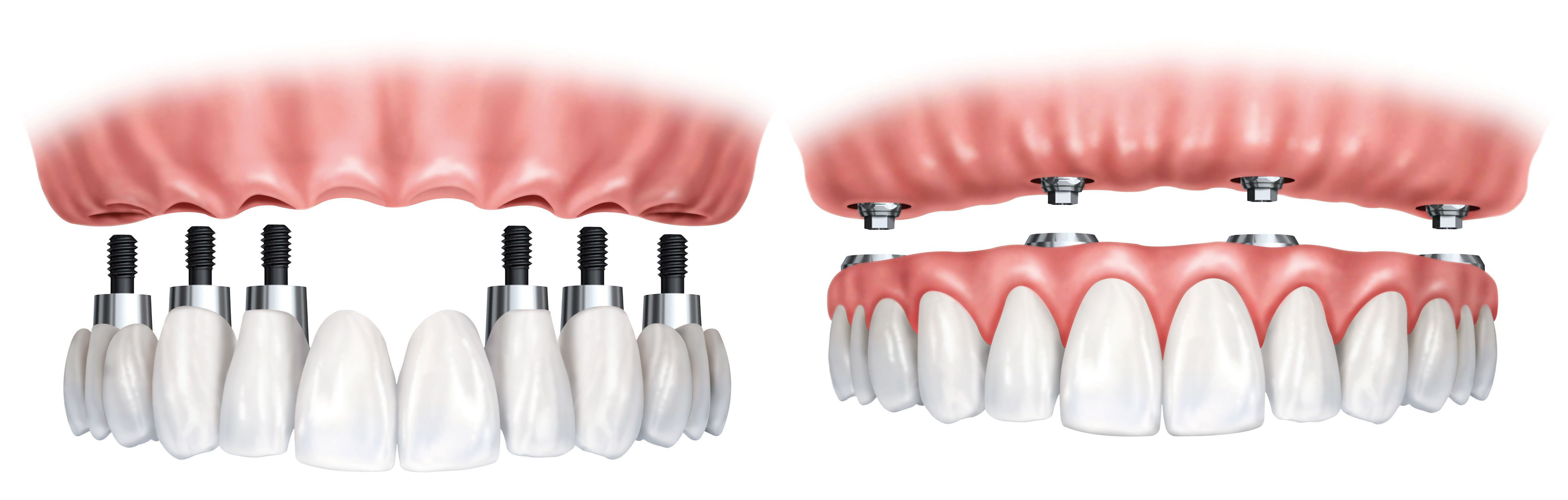 Имплантация зубов all on 6. Имплантация зубов на 6 имплантах верхней челюсти. Имплантация челюсти на 4 имплантах. Имплантация челюсти на 6 имплантах. Имплантация all-on-6 (имплантация на 6 имплантах).