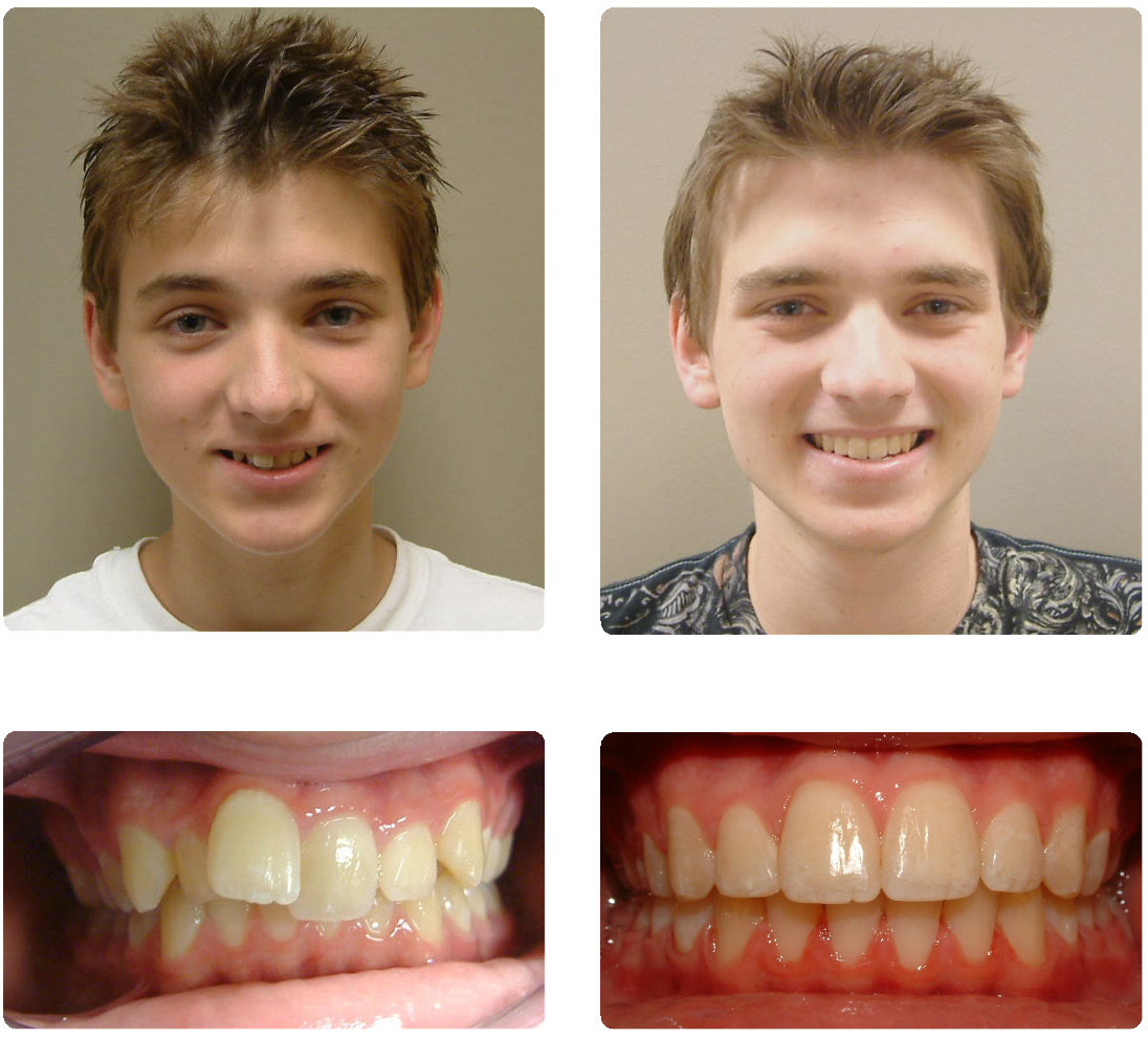 Изменения после брекетов. Выравнивание зубов до и после. Кривые зубы до и после брекетов.