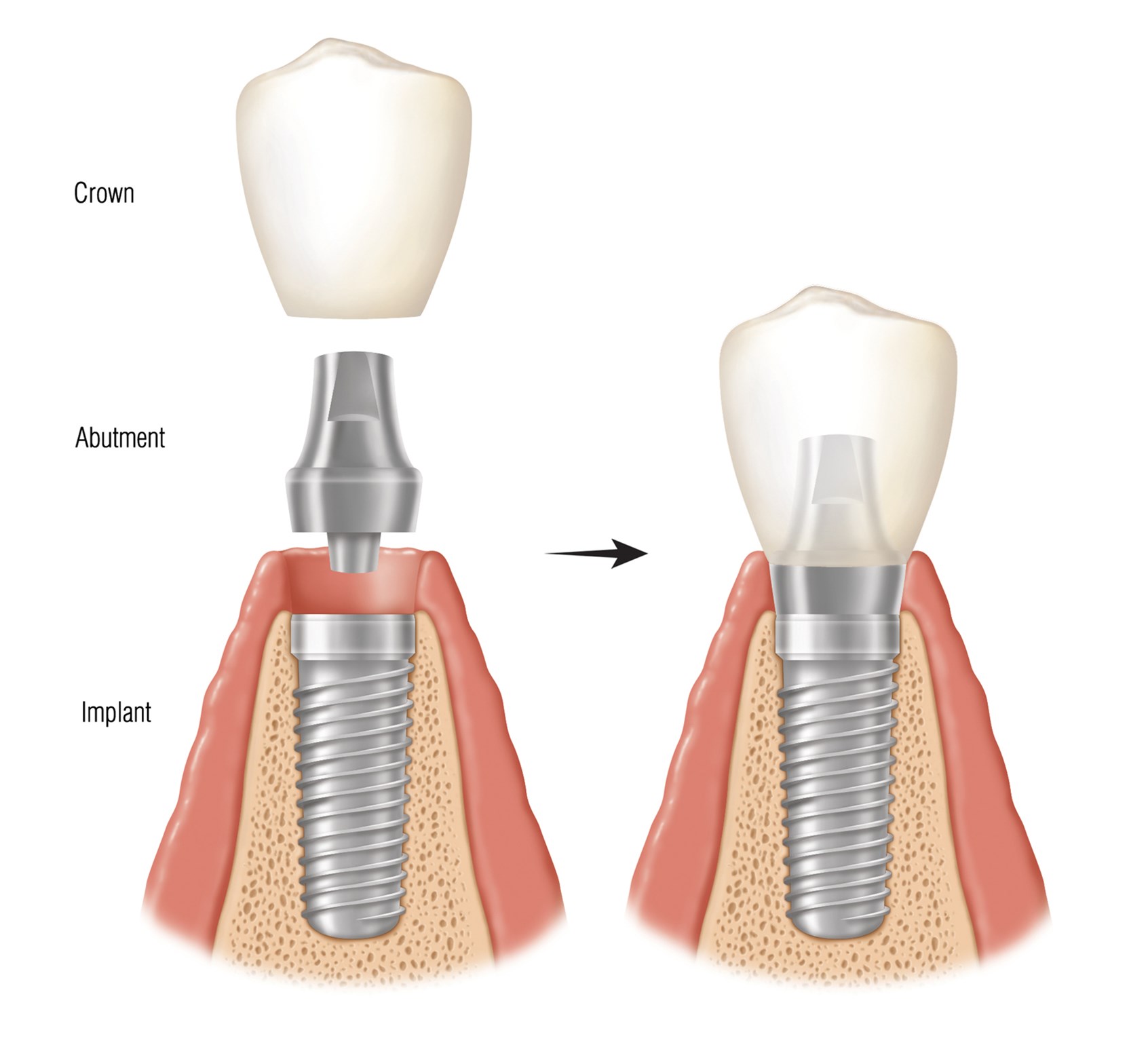 Зубы импланты поэтапно. Имплант зуба Osstem. Двухэтапная имплантация. Двухэтапная имплантация зубов.