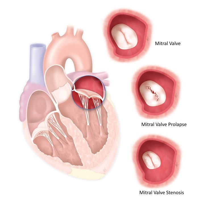 Пролапс митрального клапана картинка