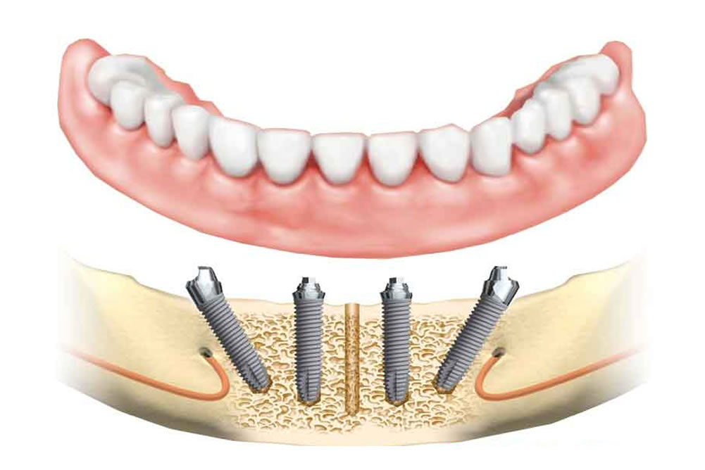 Имплантация sup aznona com. Имплантация all on 4 челюсть. Имплантация челюсти на 4 имплантах. Протез нижней челюсти на 4 имплантах.