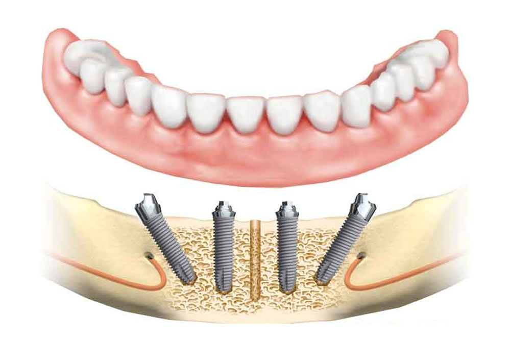 Нижние импланты. Имплантация зубов all-on-4. Система имплантации all-on-4. Схема имплантации all on 4.
