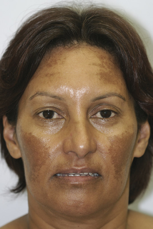 Что такое мелазма кожи лица фото до и после