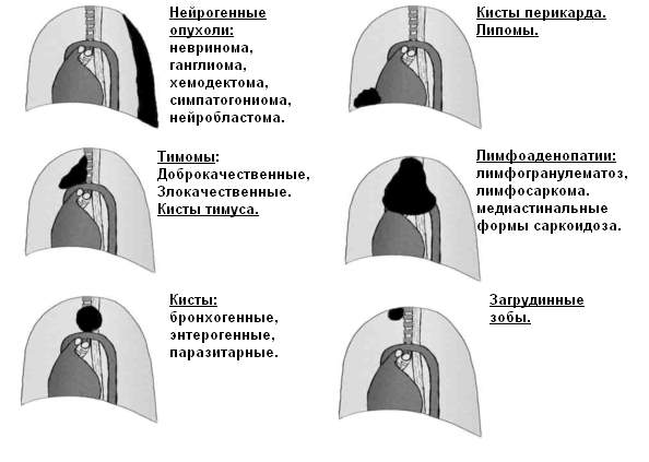 Локализация опухолей средостения