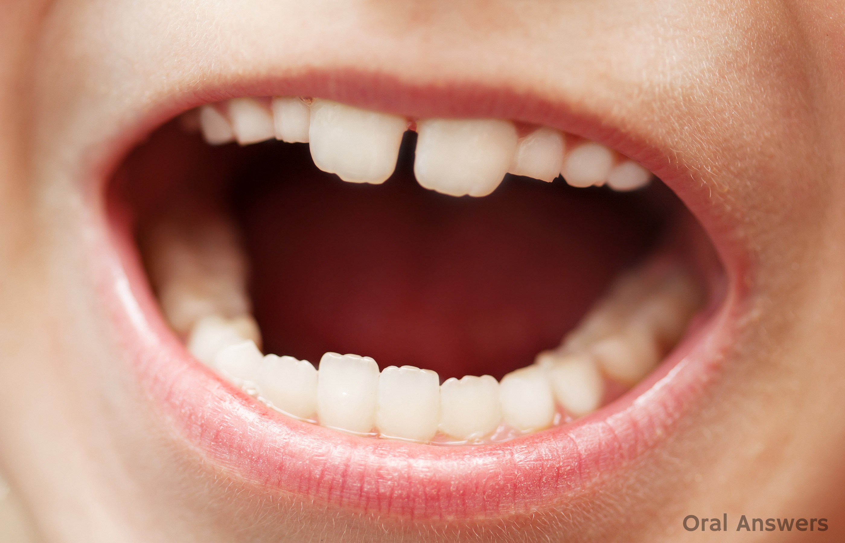 Здоровые зубы открытый рот