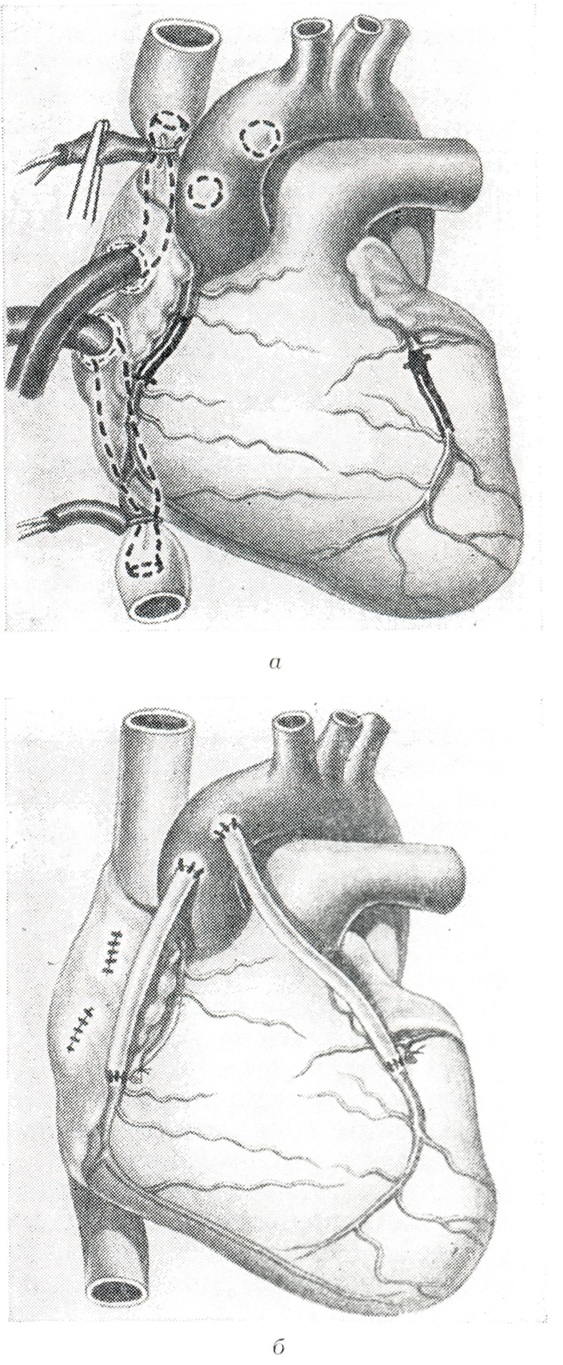 Аортокоронарное шунтирование схема операции