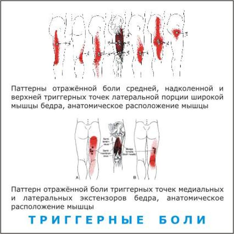 Боль поясница слева отдает в ногу. Триггеры мышц задней поверхности бедра. Триггерные точки бедра. Триггерные точки мышц бедра. Триггерные точки мышц ног.