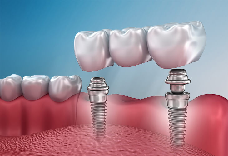 Протезирование на имплантатах фото
