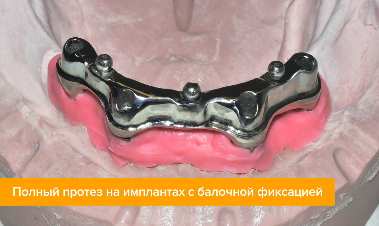 Фото полного протеза на имплантах с балочной фиксацией