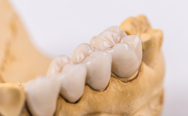 Фото зубов из металлокерамики