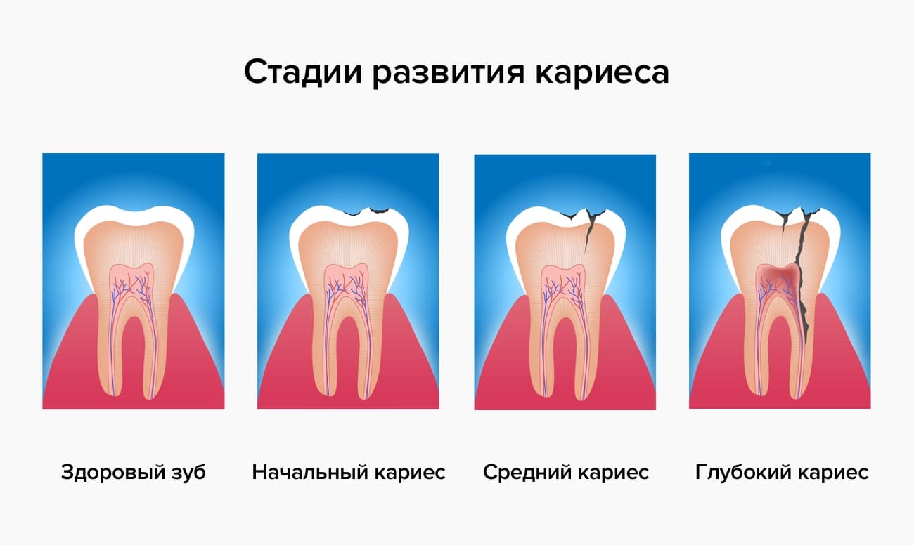 Стадии развития кариеса Стадии развития кариеса в картинках
