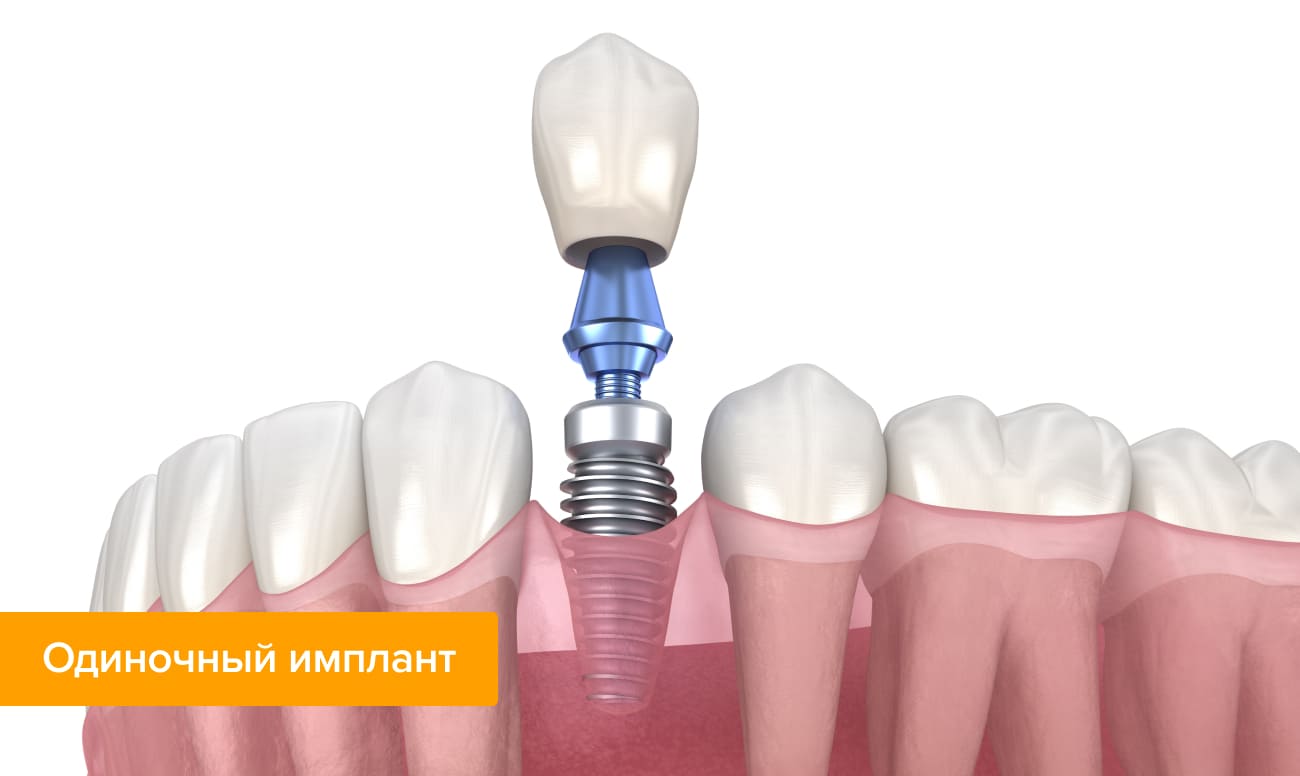 Одноэтапная имплантация