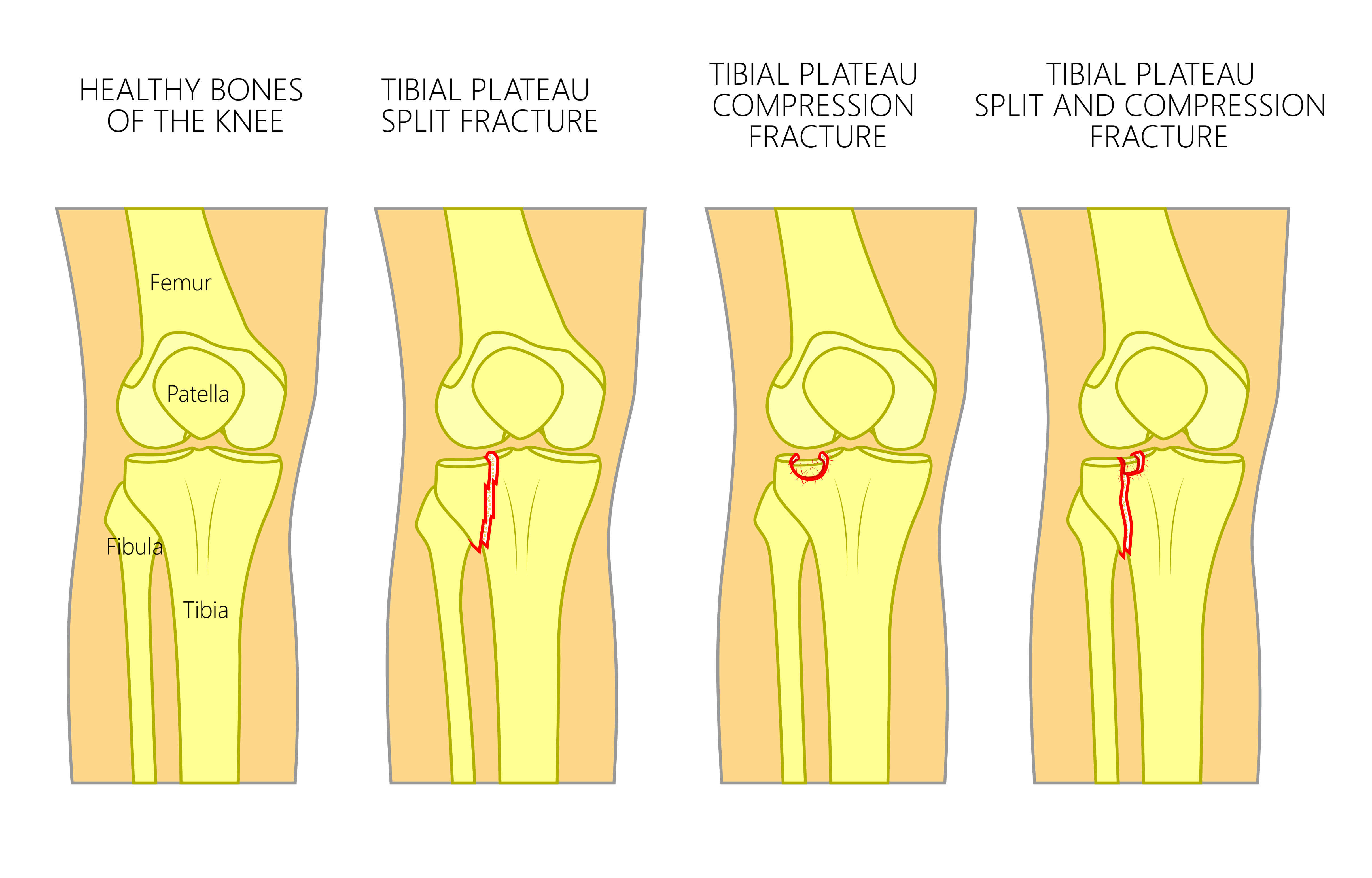 Сколько болит перелом кости. Перелом коленч. Перелом коленного сустава. Травма коленной чашечки.