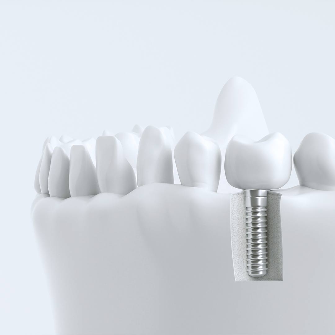Зубные имплантаты стелс
